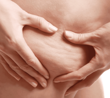 Rimedio cellulite ossigeno ozono terapia 360x320