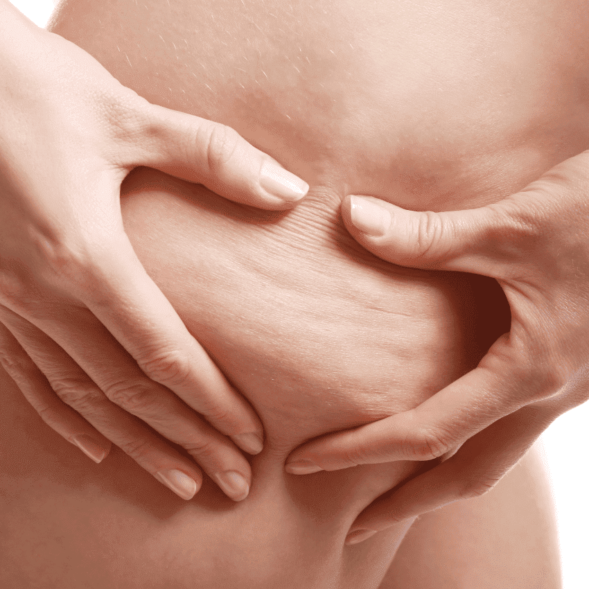 Rimedio cellulite ossigeno ozono terapia